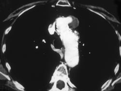 Focal Aneurysm Off the Aortic Arch - CTisus CT Scan