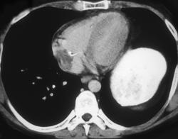 Clot Around Catheter Tip in Right Atrium - CTisus CT Scan