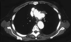 Focal Aneurysm - CTisus CT Scan