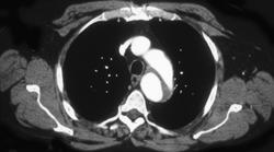 Aortic Dissection - CTisus CT Scan