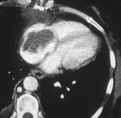 Tumor (lymphoma) Involves the Right Side of the Heart - CTisus CT Scan