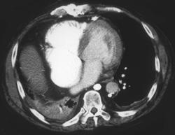 Dilated SVC With Heart Failure - CTisus CT Scan