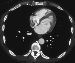 Clot in Inferior Vena Cava (IVC) - CTisus CT Scan