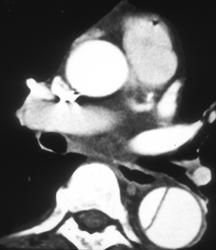 Aortic Dissection - CTisus CT Scan