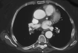 Pulmonary Embolism - CTisus CT Scan