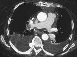 Poor Cardiac Function With Poor Left Ventricular Function - CTisus CT Scan