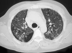 Interstitial Fibrosis - CTisus CT Scan