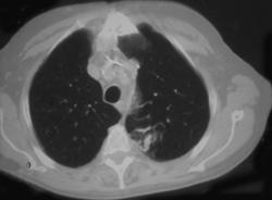 Hemorrhage S/P Lung Biopsy - CTisus CT Scan