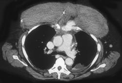 Tear in Right Ventricle With Chest Wall Hematoma - CTisus CT Scan