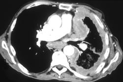 Thymoma - CTisus CT Scan