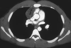 Dermoid Tumor - CTisus CT Scan