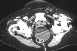 Pulmonary Embolism With Deep Vein Thrombosis (DVT) - CTisus CT Scan