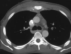 Infection (right Sternoclavicular Joint) - CTisus CT Scan