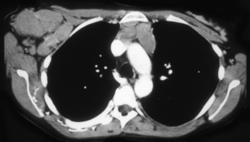 Lymphoma - CTisus CT Scan