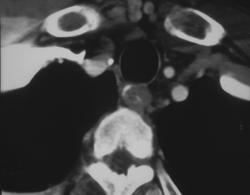 Inflammatory Mass Esophagus - CTisus CT Scan