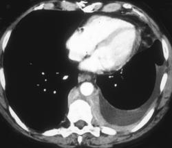 Lymphoma - CTisus CT Scan