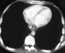 Esophageal Cancer - CTisus CT Scan