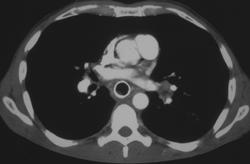 Aspiration in Patient With Esophageal Cancer - CTisus CT Scan