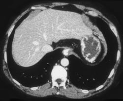 Esophageal and Gastric Varices - CTisus CT Scan