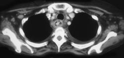 Esophagitis - CTisus CT Scan