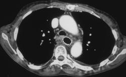 Esophageal Cancer With Nodes - CTisus CT Scan