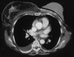 Breast Cancer With Muscle Metastases and Right Pleural Effusion - CTisus CT Scan