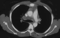 Lymphoma - CTisus CT Scan