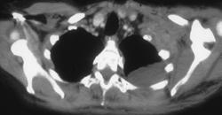 Tumor Infiltrates the Left Axilla - CTisus CT Scan