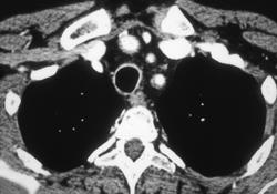 Takayasu's Arteritis With Thickened Left Subclavicular Artery - CTisus CT Scan