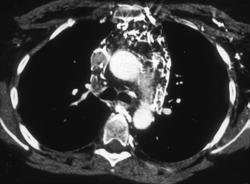 SVC Thrombosis With Collaterals and Hot Spot in the Liver - CTisus CT Scan