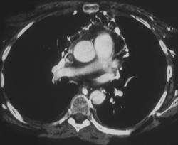 Mediastinal Collaterals in SVC Syndrome - CTisus CT Scan