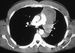 Lymphoma - CTisus CT Scan