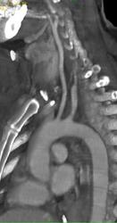 Minimal Stenosis at Origin of Left Subclavian Artery - CTisus CT Scan