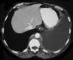 Posterior Mediastinal Nodes Due to Lymphoma - CTisus CT Scan