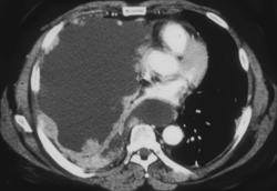 Pleural Implants in Breast Cancer - CTisus CT Scan