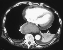 Posterior Mediastinal Hematoma - CTisus CT Scan