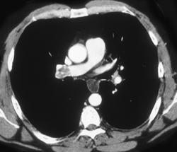 Pulmonary Embolism - CTisus CT Scan