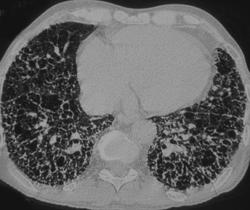 Idiopathic Pulmonary Fibrosis - CTisus CT Scan