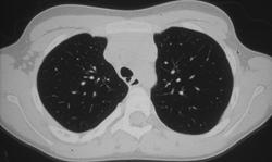 Diverticulum of Trachea - CTisus CT Scan