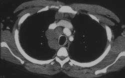 Lymphoma - CTisus CT Scan