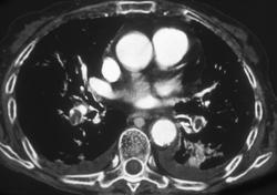 Multiple Pulmonary Emboli - CTisus CT Scan