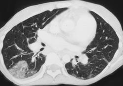 Bronchioalveolar Carcinoma - CTisus CT Scan