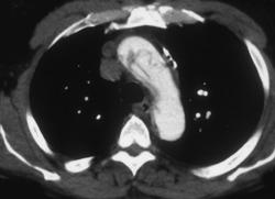 Aortic Dissection - CTisus CT Scan