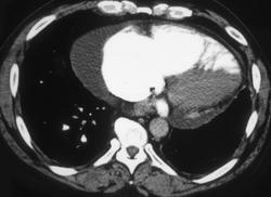 Poor Cardiac Function and Pericardial Effusion - CTisus CT Scan