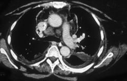 Pneumomediastinum - CTisus CT Scan