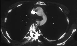 Repaired Coarctation of the Aorta - CTisus CT Scan