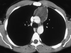 Thymic Hyperplasia - CTisus CT Scan