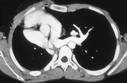 Single Ventricle - CTisus CT Scan