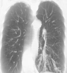 Bronchiectasis - CTisus CT Scan