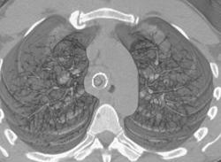 Multiple Stents in the Airway - CTisus CT Scan